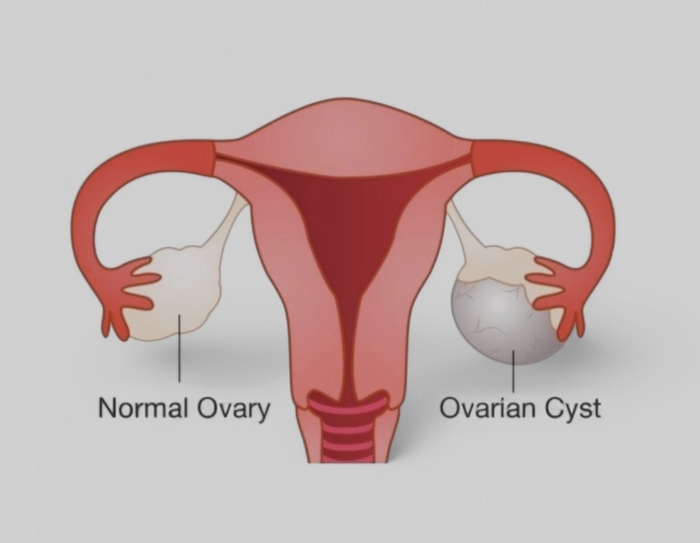 Ovarian Cyst